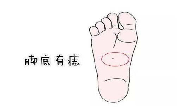 脚痣相