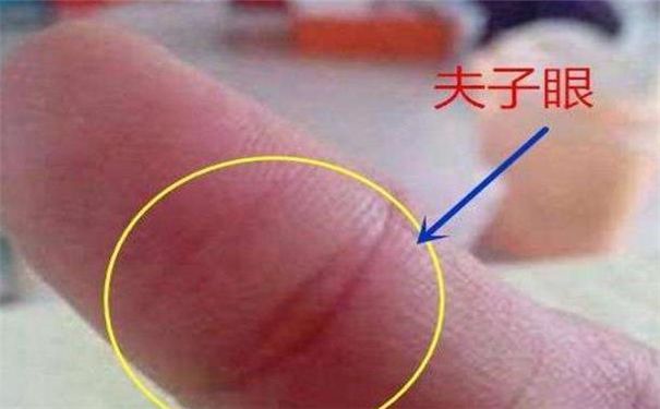 什么是夫子眼