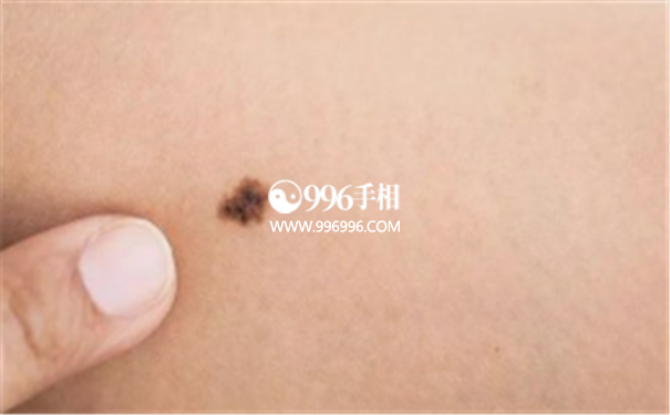 男人克妻痣