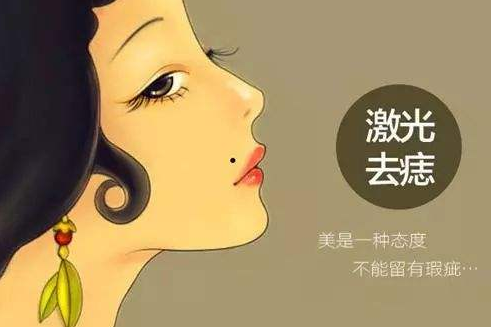 激光点痣