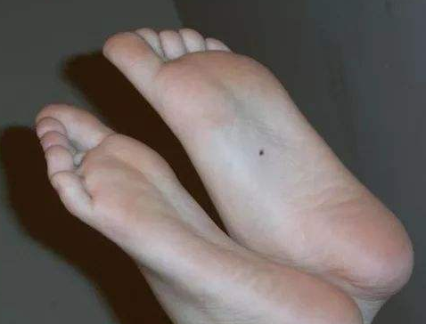 点痣