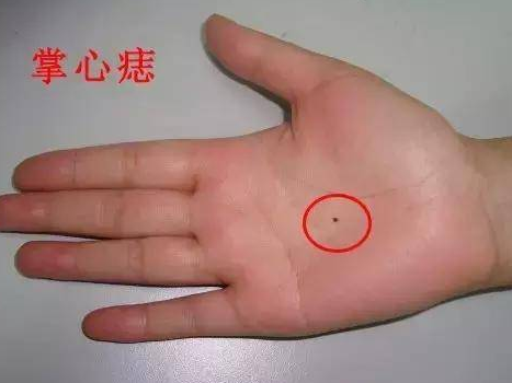 女人10处有痣是富贵痣