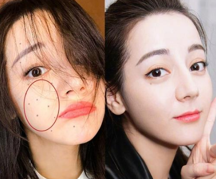 点痣后注意什么
