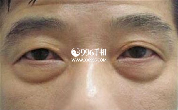 男人眼袋有痣代表