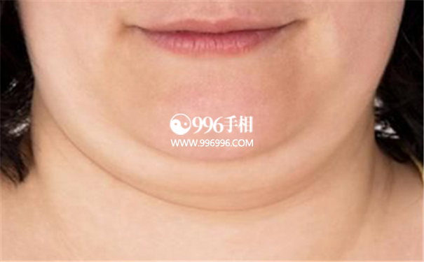 双下巴