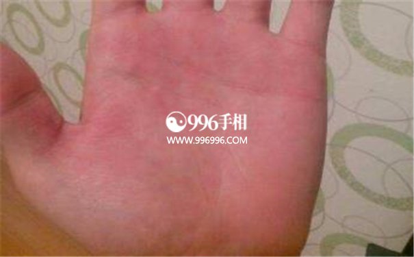 肝病手掌纹